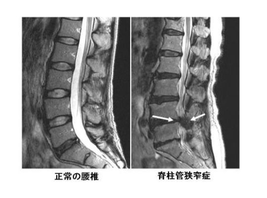 名古屋市の整体の脊柱管狭窄症画像