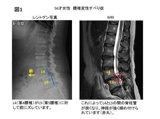 名古屋市の整体のすべり症画像